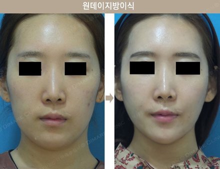 매직브이라인 + 원데이지방이식