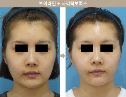 브이라인 + 사각턱보톡스