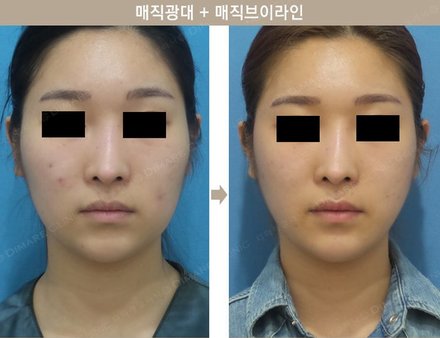 매직광대 + 매직브이라인