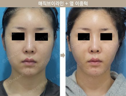 매직브이라인 + 옆 이중턱