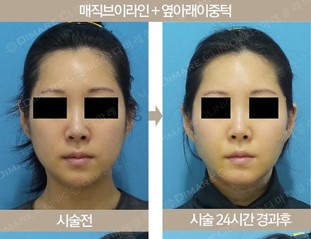 매직브이라인 + 옆아래이중턱