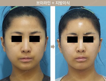 브이라인 + 지방이식