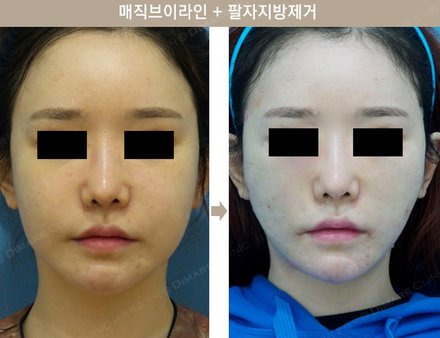 매직브이라인 + 팔자지방제거