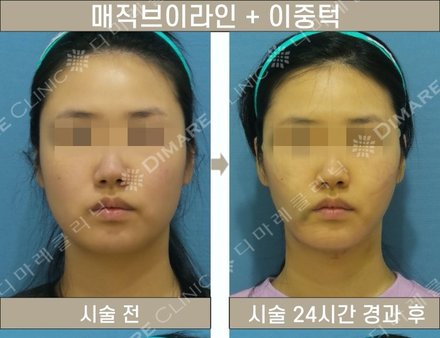 매직브이라인 + 이중턱