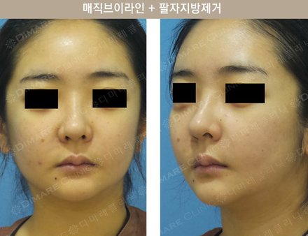 매직브이라인 + 팔자지방제거