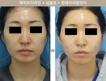 매직브이라인 + 심술보 + 원데이지방이식