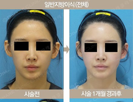 얼굴 전체 지방이식