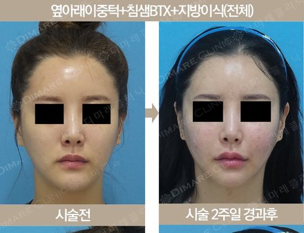 옆아래이중턱 + 침샘BTX + 일반지방이식(전체)
