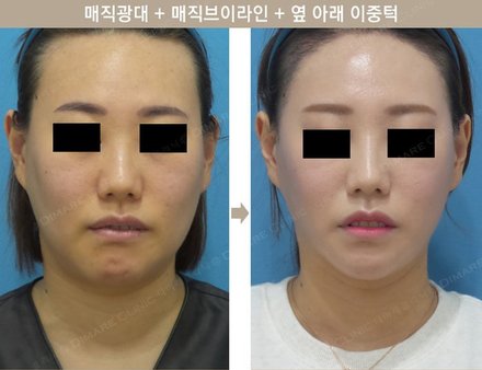 매직 광대 + 매직 브이라인 + 옆 이중턱