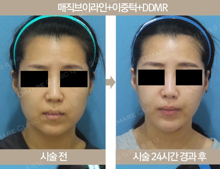 매직 브이라인 + 이중턱 + DDMR