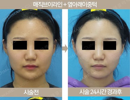 매직브이라인 + 옆아래이중턱