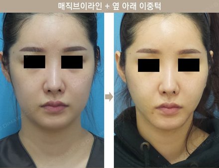 매직브이라인 + 옆 아래 이중턱