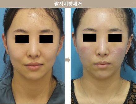 팔자지방제거