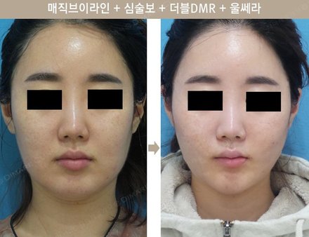 메직브이라인 + 심술보 + 더블DMR + 울쎄라
