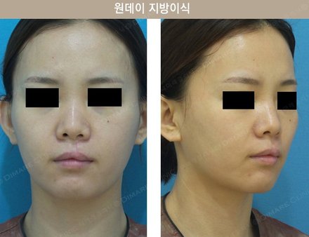 원데이지방이식