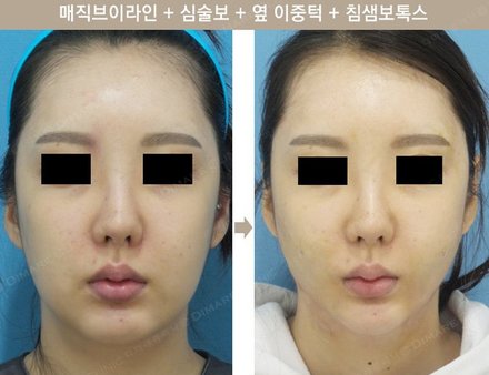 매직브이라인 + 심술보 + 옆이중턱 + 침샘보톡스