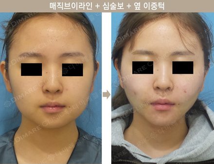 매직브이라인 + 심술보 + 옆 이중턱