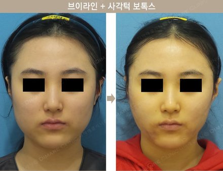 브이라인 + 사각턱 보톡스