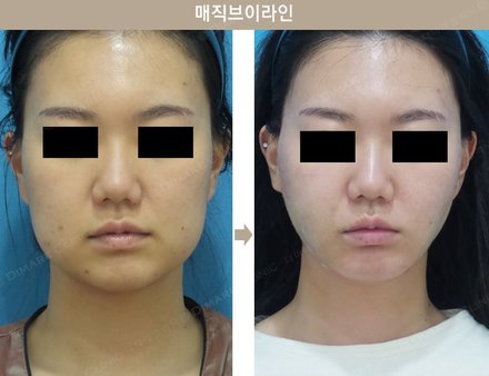 매직브이라인