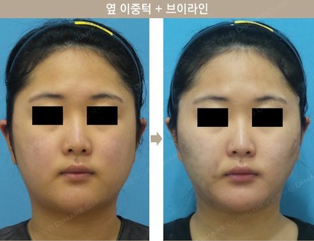 옆이중턱 + 브이라인