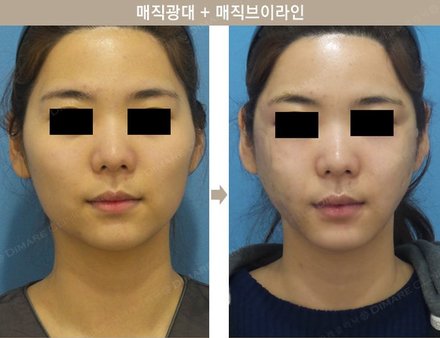 매직광대 + 매직브이라인