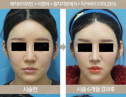 매직브이라인+이중턱+팔자지방제거+리커버리 (이마,관자)