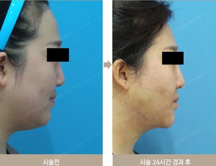 옆 아래 이중턱
