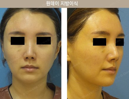 원데이지방이식