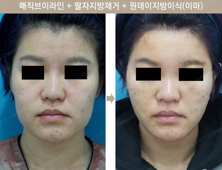 매직브이라인 + 팔자지방제거 + 원데이지방이식(이마)
