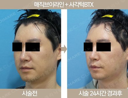 매직브이라인 + 사각턱BTX