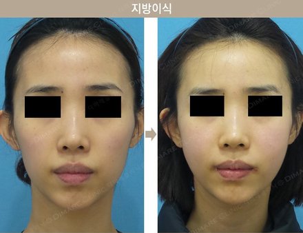 원데이 지방이식 (얼굴전체)