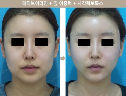 매직브이라인 + 옆 이중턱 + 사각턱 보톡스