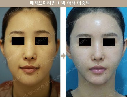 매직브이라인 + 옆 아래 이중턱