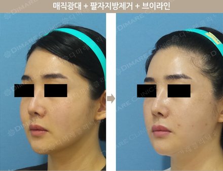 매직광대 + 팔자지방제거 + 브이라인