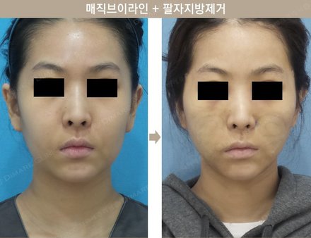 매직브이라인 + 팔자지방제거