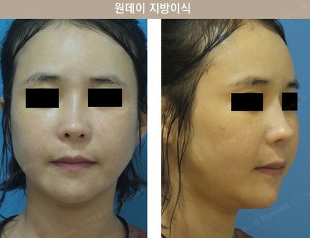 원데이지방이식