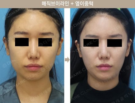 매직브이라인 + 옆이중턱