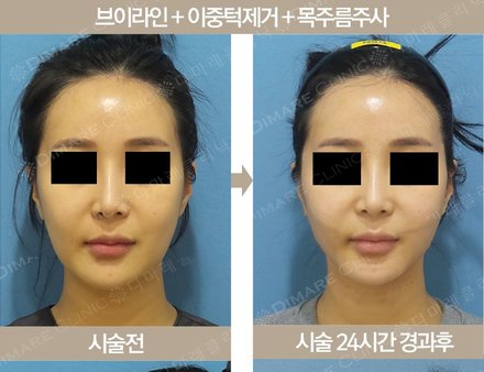 브이라인 + 이중턱제거 + 목주름주사
