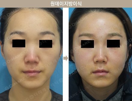 원데이지방이식