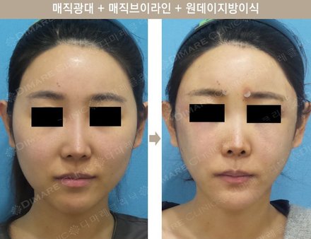 매직광대 + 매직브이라인 + 원데이지방이식