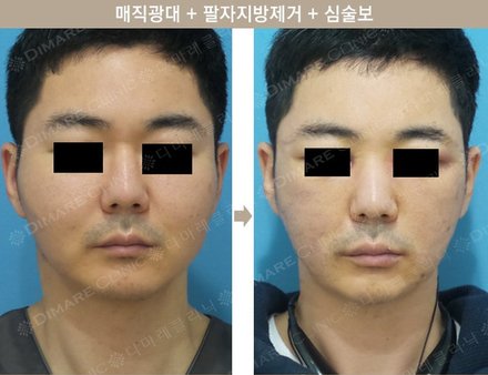 매직광대 + 팔자지방제거 + 심술보