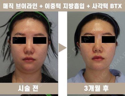 매직 브이라인 + 이중턱 지방흡입 + 사각턱 BTX