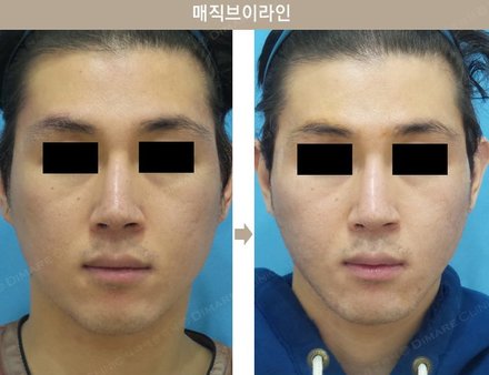 매직브이라인