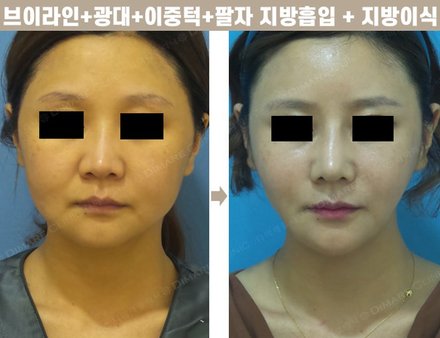 브이라인 + 광대 + 이중턱 + 팔자지방제거 + 지방이식