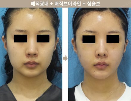 매직광대 + 매직브이라인 + 심술보