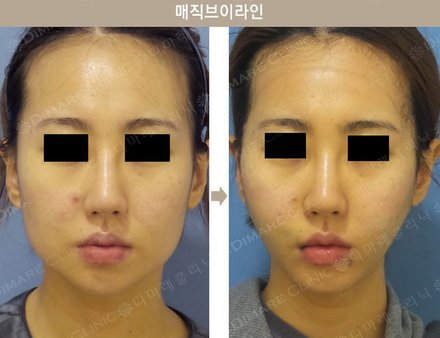 매직브이라인