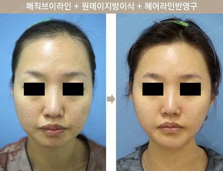 매직브이라인+일반지방이식+헤어라인반영구