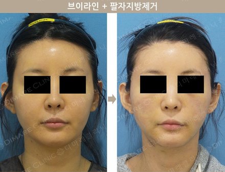 브이라인 + 팔자지방제거