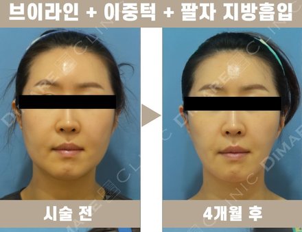 브이라인 + 이중턱 + 팔자 지방흡입