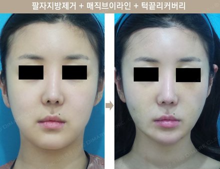팔자지방제거 + 매직브이라인 + 턱끝리커버리